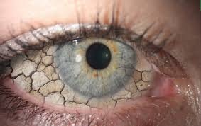Tratamento do olho seco